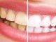 Maneras de blanquear los dientes