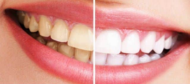 Maneras de blanquear los dientes